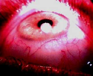 Befall der Augen, Morgellonsfibern im Auge, Biofilm ber der Hornhaut. Bildquelle Anne Dill